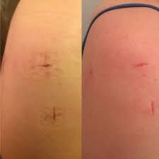 The Fourth Week Post Op Shoulder Surgery Recovery Shoulder Surgery Rotator Cuff Surgery