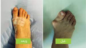 إصابات القدم والكاحل drnasef