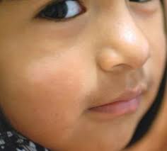 The exact cause of pityriasis alba is not known. Pigmentstorungen Helle Flecken Und Dunkle Knoten Pz Pharmazeutische Zeitung