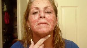 Victoria sharon explains how to look for the most common signs of skin cancer, also known as th. Skin Cancer My Vlog Journal Treatment W Efudex Vid 10 Youtube