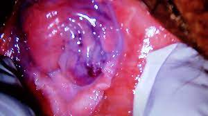Varices Vulvares En El Embarazo Youtube