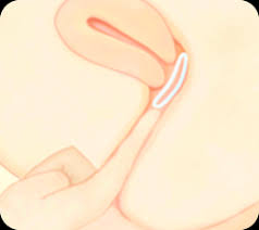 Choose an insertion position that is most comfortable for you. How To Insert Nuvaring Etonogestrel Ethinyl Estradiol Vaginal Ring