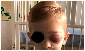 Image result for phlegmon on face)