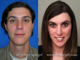 Be prepared for an emotional roller coaster another thing to keep in mind: Facial Feminization Surgery A Rebirth For Transgender Women The Star