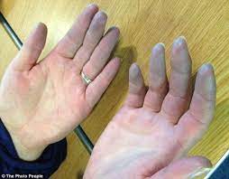 Heute morgen aufgewacht und festgestellt, das ich darum: Blaue Finger Med Kom