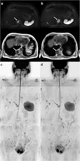 In published clinical trials, the most commonly used imaging modalities for the detection and evaluation of therapeutic response are bone scan, abdominopelvic … Whole Body Magnetic Resonance Imaging Wb Mri Reporting With The Metastasis Reporting And Data System For Prostate Cancer Met Rads P Inter Observer Agreement Between Readers Of Different Expertise Levels Cancer Imaging Full Text