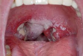 Pin On Strep Throat Symptoms