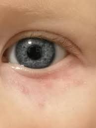 Ausschlag Unterm Auge Forum Baby Urbia De