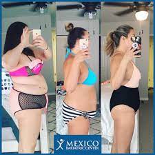 Gastric bypass surgery before and after: Gastric Sleeve Before And After Photos The Best Pictures Of 2020