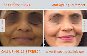 It is a technique that directs sharp and concentrated vibrating rays of light at damaged skin removing the skin layer by layer. Anti Aging Treatment Mumbai Wrinkles Treatment Cost India The Esthetic Clinics