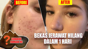 Check spelling or type a new query. Cara Cepat Menghilangkan Jerawat Secara Alami Dalam 1 Hari