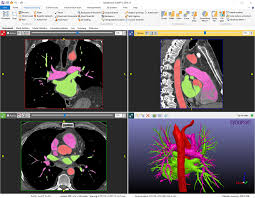 Simpleware Scanip Showing Heart Model Devices Design Image Processing Data Visualization