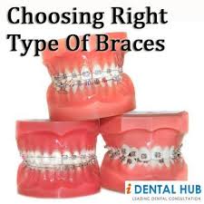 What Kind Of Orthodontic Braces Do I Need What Type Of Braces Are Available There Are Many Kinds Of Braces Th Orthodontics Braces Dental Braces Orthodontics