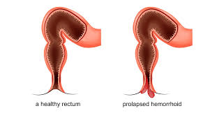 تدلي البواسير الأسباب والأعراض وطرق العلاج ويب طب