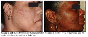 Image result for Postinflammatory Hyperpigmentation