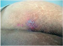 Herpes on the buttocks | herpes on tongue. Characteristic Cluster Of Herpetic Vesicles Buttocks Download Scientific Diagram
