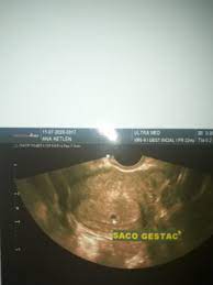 4 Semanas Apenas O Saco Gestacional Tentando Engravidar Principal Babycenter