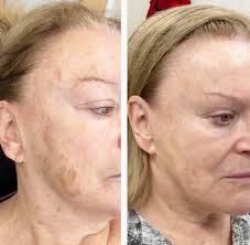 One of our favourite client results with IPL! 👏 IPL photofacial can be  used in treating brown spots, age spots, sun spots, broken capillaries,  rosacea, and fine lines. Leaving the skin looking