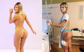 0 ответов 0 ретвитов 0 отметок «нравится». Compare Bumbum De Andressa Urach Antes E Depois Da Infeccao Por Hidrogel Folha De S Paulo Scoopnest