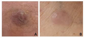 Image result for Merkel Cell Carcinoma