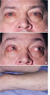 Image result for Neurosyphilis