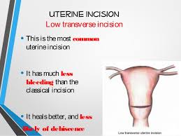 Cesarean Section Cs