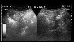 In a very small percentage of cases, a dermoid cyst in the ovary can turn into cancer. A Gallery Of High Resolution Ultrasound Color Doppler 3d Images Ovaries