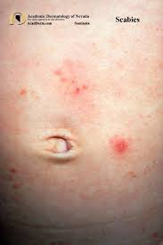 Image result for scabies on genitals
