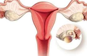 Aki kezeli a parazitákat platyhelminthes bél nyílások, a paraziták összesített eloszlása fekete kömény parazita kezelés. Tratamente Naturale Eficiente Pentru Dizolvarea Chisturilor Ovariene Èi Reducerea Simptomelor Cauzate De Acestea Secretele Com