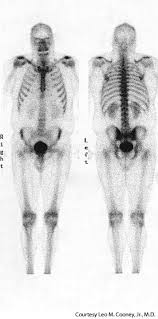 Bone Scan Information From Answers Com Nuclear Medicine Pet Ct Nuclear Med