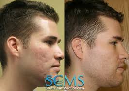 We did not find results for: Laser Skin Resurfacing Before After La San Diego Acne Scar Removal Acne Scar Cure How To Get Rid Of Acne