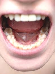 Quantos dentes temos na boca? É normal ter mais ou menos?