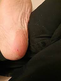 To avoid accidentally cutting yourself, remove anythi. Callus Shaver Wikipedia