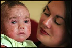 Baby Elliot born with second skin