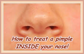 In this article, learn more about the causes and treatments, plus when to see a doctor. How To Get Rid Of A Pimple Inside Your Nostril Gallery