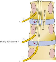 The nerve passing to the next level runs over a weak spot in the disc space, which is the reason discs tend to herniate right under the nerve root and can cause leg pain—often referred to as (lumbar radiculopathy or sciatica). Atlas Section Neupsy Key