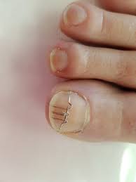 3to nagelspange zehennagel nagel eingewachsener zehennagel