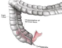 Image result for Adult Intussusception