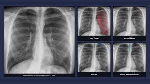 Image result for Pneumothorax