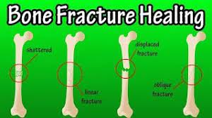 Fracture Physiopedia