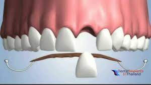 Maybe you would like to learn more about one of these? Single Tooth Missing Treatment Options In Thailand 2019 Affordable Treatment Solutions Youtube