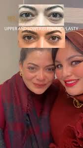 Have your youthful look by eye lift procedures at Glow clinics. Ask for  surgical eye lift surgery or non-surgical (plasmage