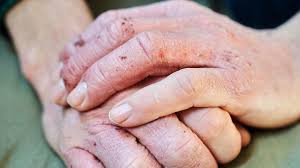 Many of these conditions on the hands or feet are itchy, but, in some people, they may psoriasis, in addition to a rash on the skin, often displays changes on the fingernails or toenails of the dyshidrotic eczema typically starts as tiny itchy blisters along the sides of the fingers or feet and then turns into. What Is Dyshidrotic Eczema Symptoms Causes Diagnosis Treatment And Prevention Everyday Health