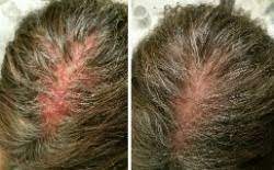 Or you could get it from a poison oak leaf. Skin Care Line For Dry Itchy Scalp Problems