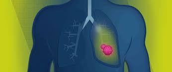 Warning signs of lung cancer are not always present or easy to identify. At The Forefront Of Lung Cancer Treatment