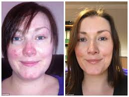 المياه المعدنية التي ش فيت امرأة مريضة بمرض الوردية Rosacea المياه المعدنية الشافية ثقف نفسك