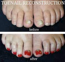 Toenail Reconstruction By Lavana At Personal Touch In Golden Bc Toe Nails Nails Nail Art