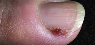 Image result for Pyogenic Granuloma