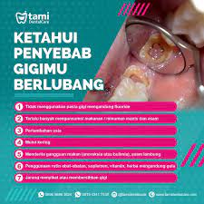 Check spelling or type a new query. Ketahui Penyebab Gigimu Berlubang Tami Dental Care Klinik Dokter Gigi Bandung Bojongsoang Turangga