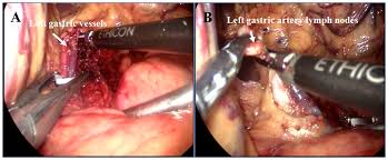 Get free medical assistance from experts. Plos One Modified Mckeown Minimally Invasive Esophagectomy For Esophageal Cancer A 5 Year Retrospective Study Of 142 Patients In A Single Institution